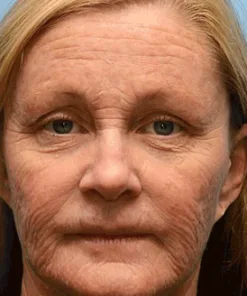 KLENIMORE™ Botox Vitamin A Retinol Anti-Wrinkle Firming and Lifting Cream