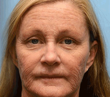 KLENIMORE™ Botox Vitamin A Retinol Anti-Wrinkle Firming and Lifting Cream Last Day for Limited Time 70 OFF