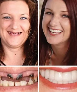 KLENIMORE™ Medical Full Denture with Strong Suctiond