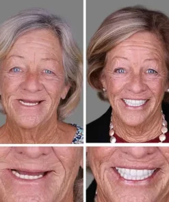 KLENIMORE™ Medical Full Denture with Strong Suctiond