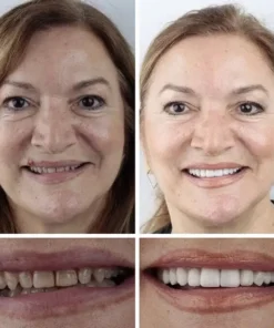 KLENIMORE™ Medical Full Denture with Strong Suctiond