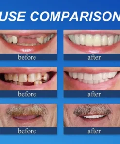 KLENIMORE™ Medical Full Denture with Strong Suctiond