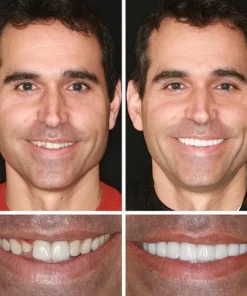 KLENIMORE™ Medical Full Denture with Strong Suctiond