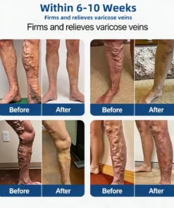 KLENIMORE® 𝑽𝗲𝗶𝙣 𝘾𝐨𝐧𝘁𝗼𝙪𝙧 𝙈𝙞𝐜𝐫𝒐𝒏𝒆𝗲𝗱𝗹𝙚 𝙋𝙖𝐭𝐜𝒉