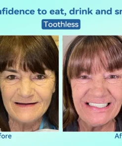 KLENIMORE® Premium Denture AdaptableFit Functional Dentures