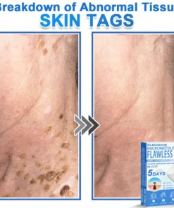 KLENIMORE™ 2-in-1 Hydrocolloid Pimple Patches
