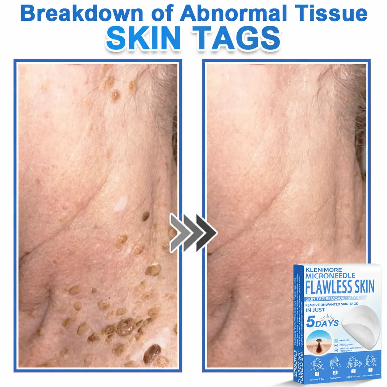 KLENIMORE™ 2-in-1 Hydrocolloid Pimple Patches