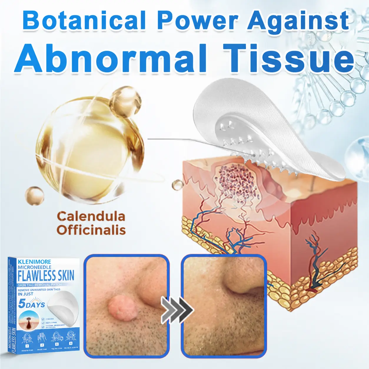 KLENIMORE™ 2-in-1 Hydrocolloid Pimple Patches