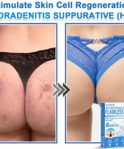 KLENIMORE™ 2-in-1 Hydrocolloid Pimple Patches