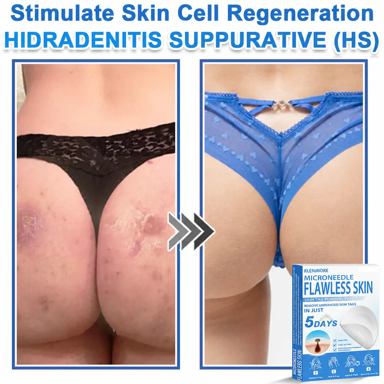 KLENIMORE™ 2-in-1 Hydrocolloid Pimple Patches