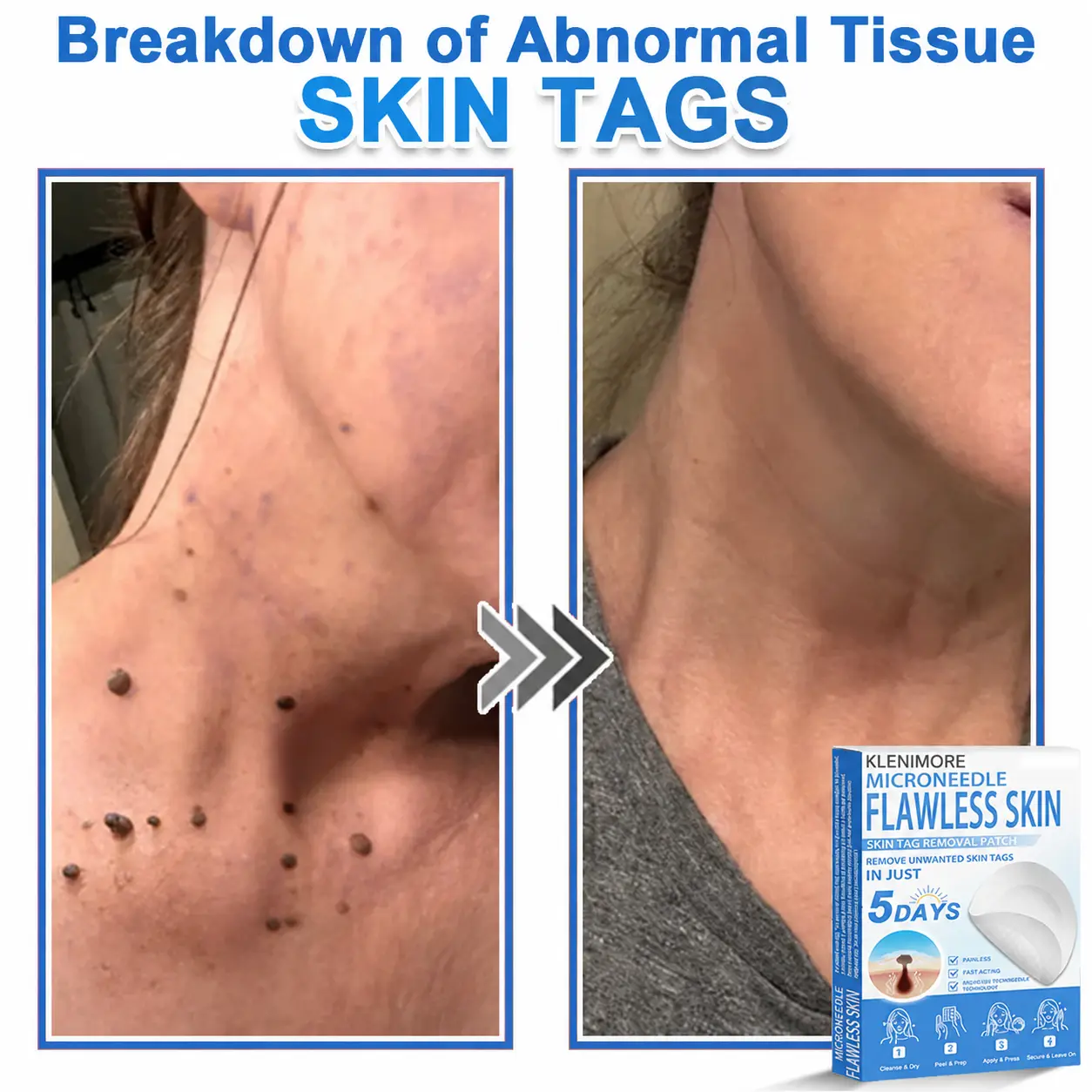 KLENIMORE™ 2-in-1 Hydrocolloid Pimple Patches