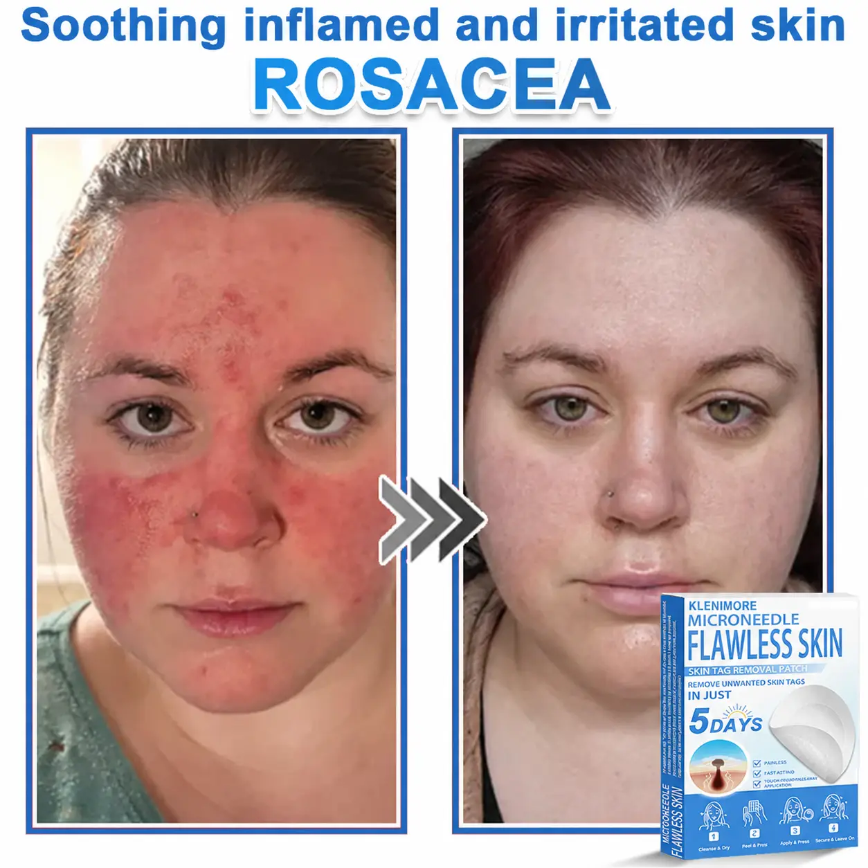 KLENIMORE™ 2-in-1 Hydrocolloid Pimple Patches