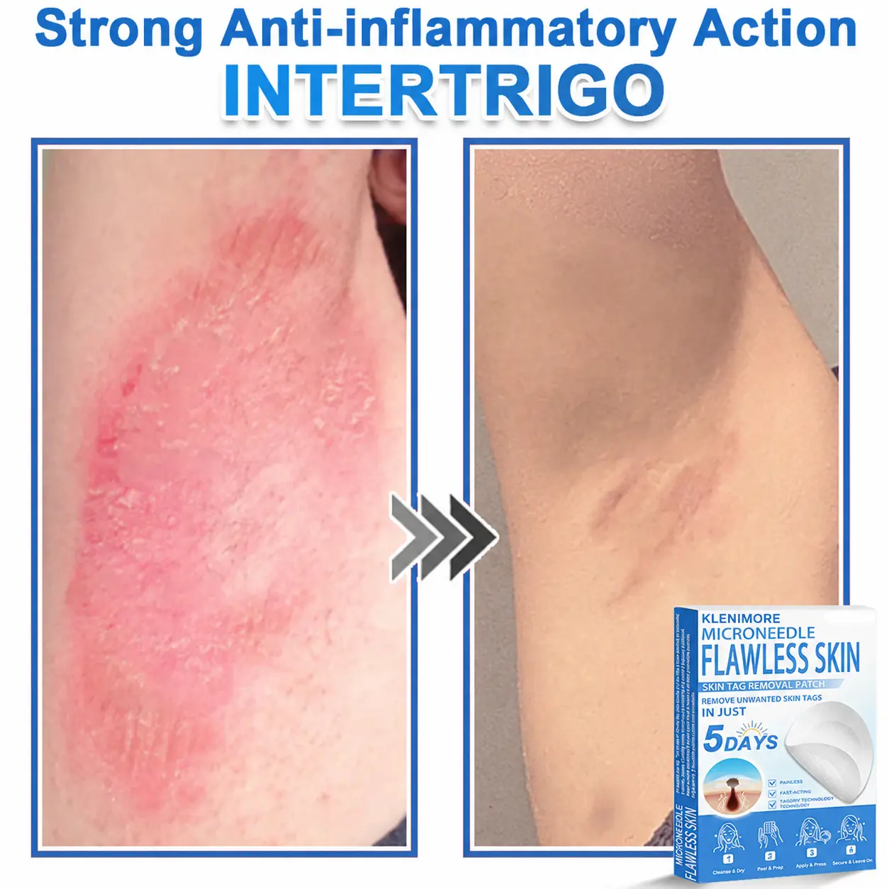 KLENIMORE™ 2-in-1 Hydrocolloid Pimple Patches