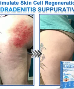 KLENIMORE™ 2-in-1 Hydrocolloid Pimple Patches