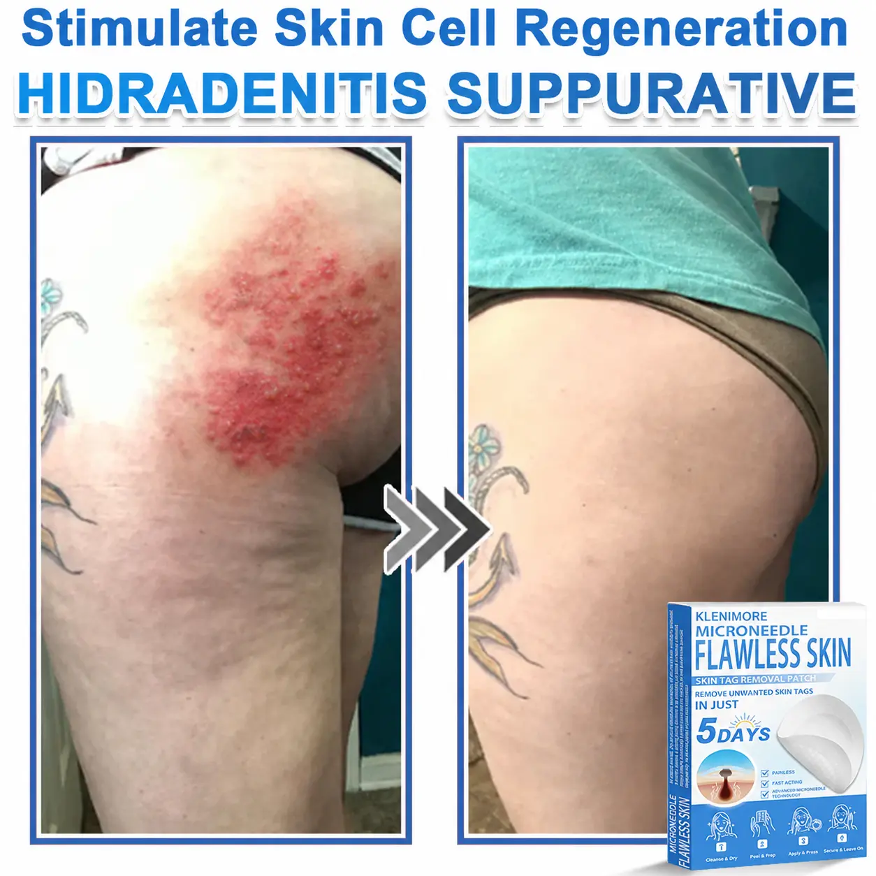 KLENIMORE™ 2-in-1 Hydrocolloid Pimple Patches