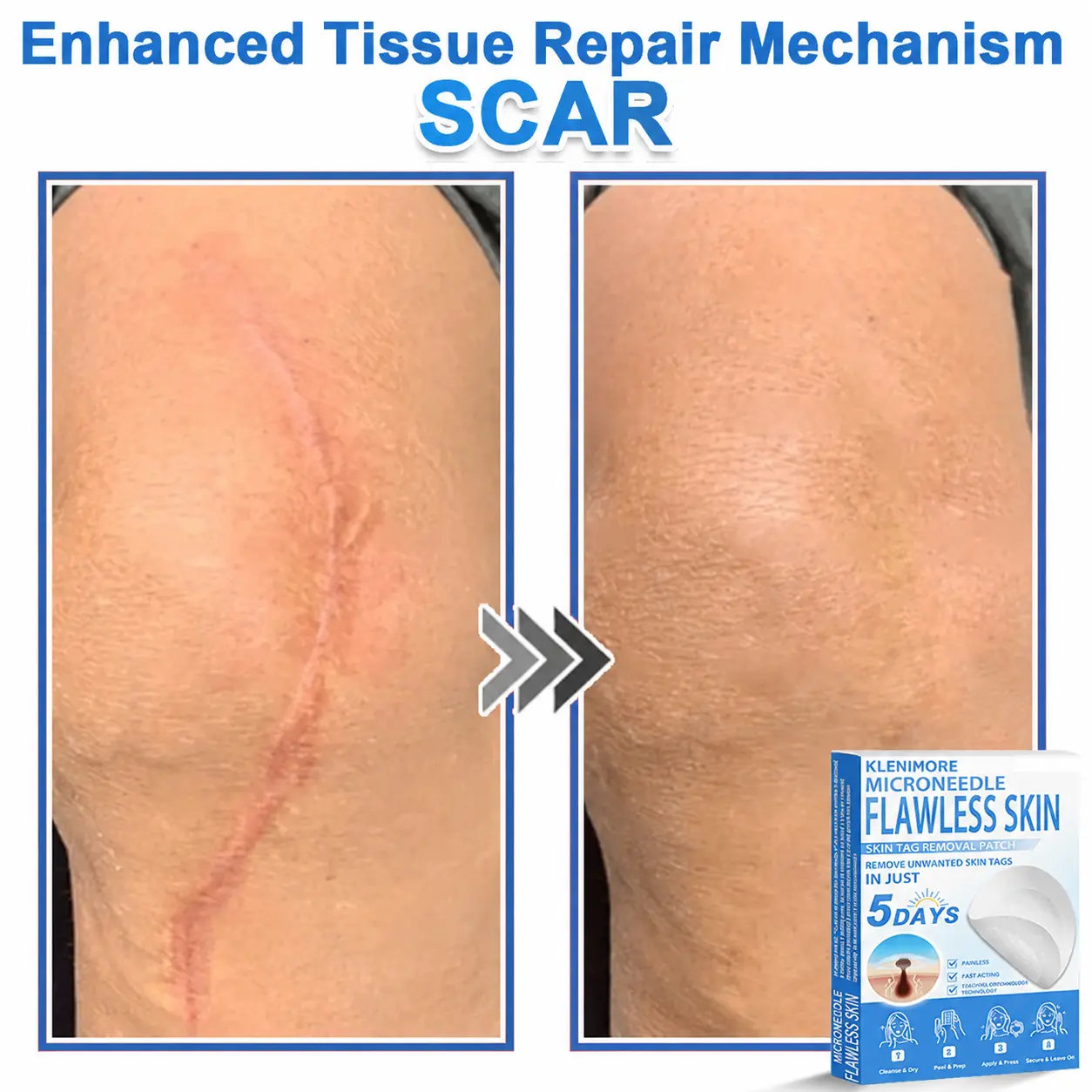 KLENIMORE™ 2-in-1 Hydrocolloid Pimple Patches