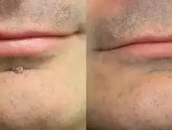 KLENIMORE™ 2-in-1 Microneedle & Hydrocolloid Patch