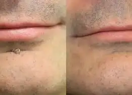 KLENIMORE™ 2-in-1 Microneedle & Hydrocolloid Patch