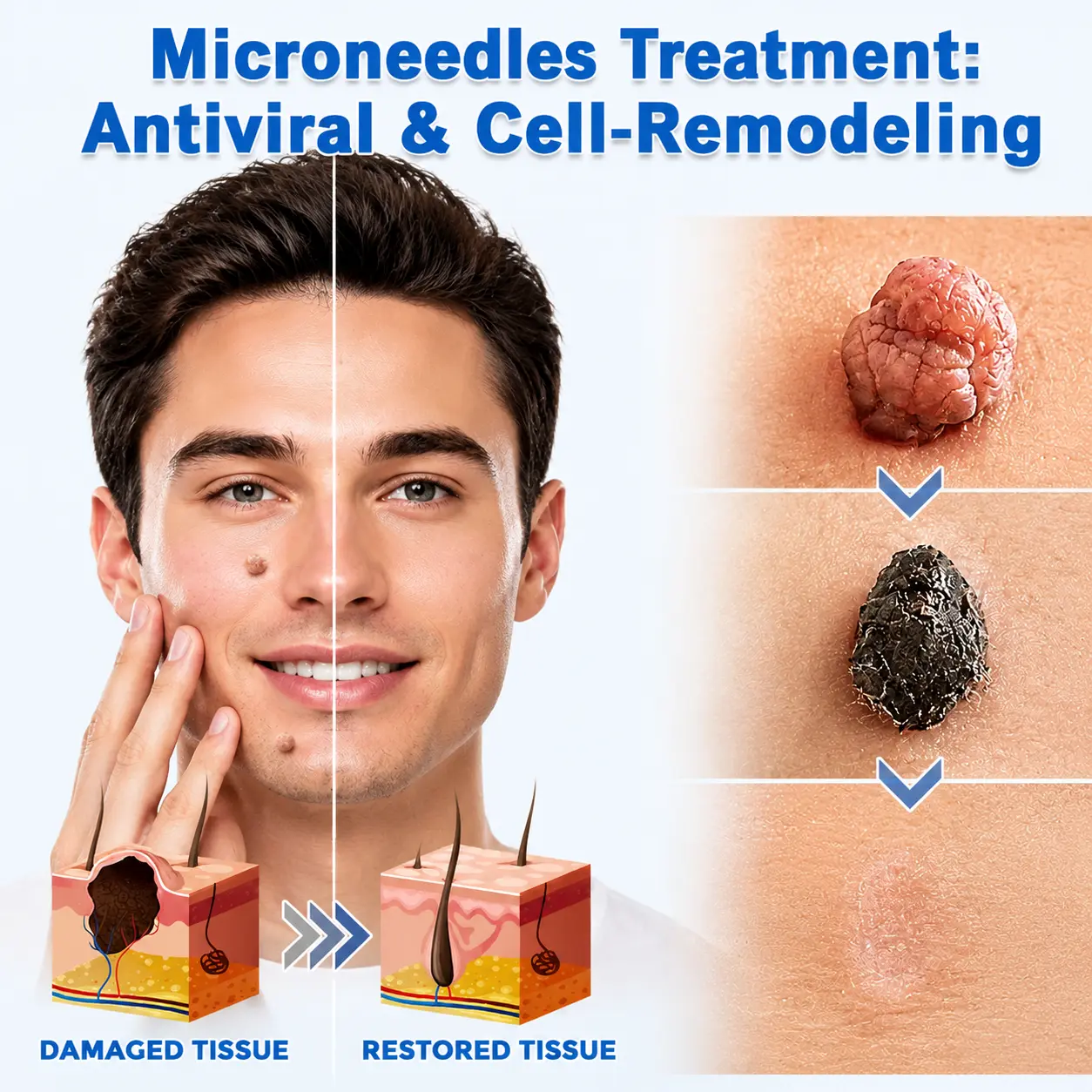 KLENIMORE™ 2-in-1 Microneedle & Hydrocolloid Patch