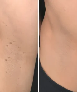 KLENIMORE™ 2-in-1 Microneedle & Hydrocolloid Patch
