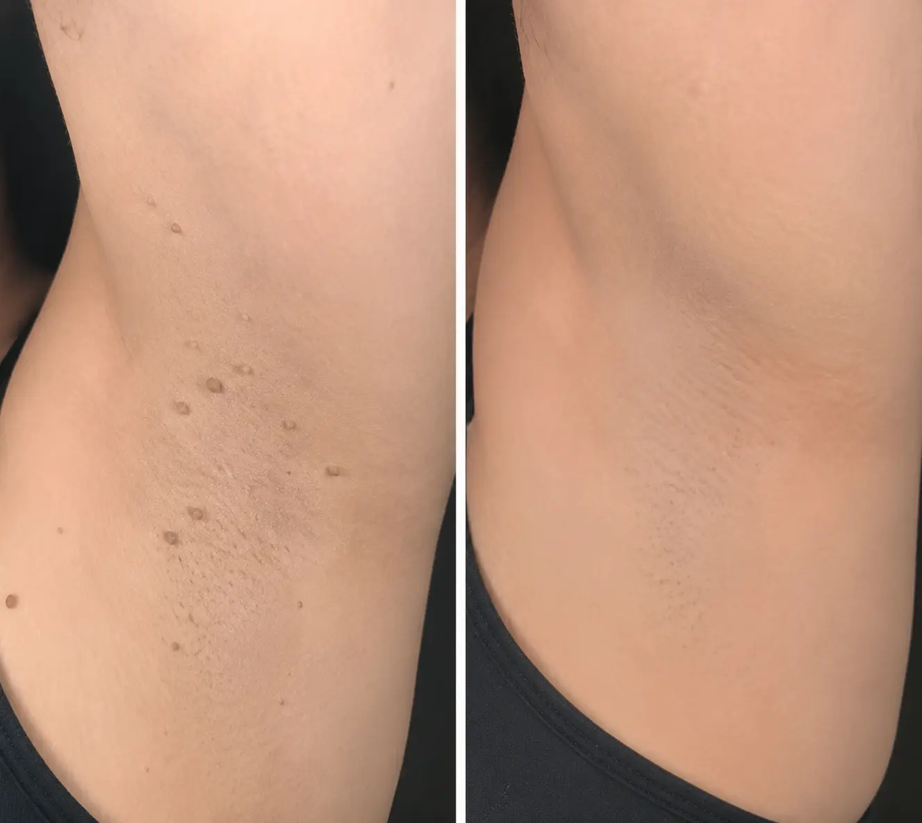 KLENIMORE™ 2-in-1 Microneedle & Hydrocolloid Patch