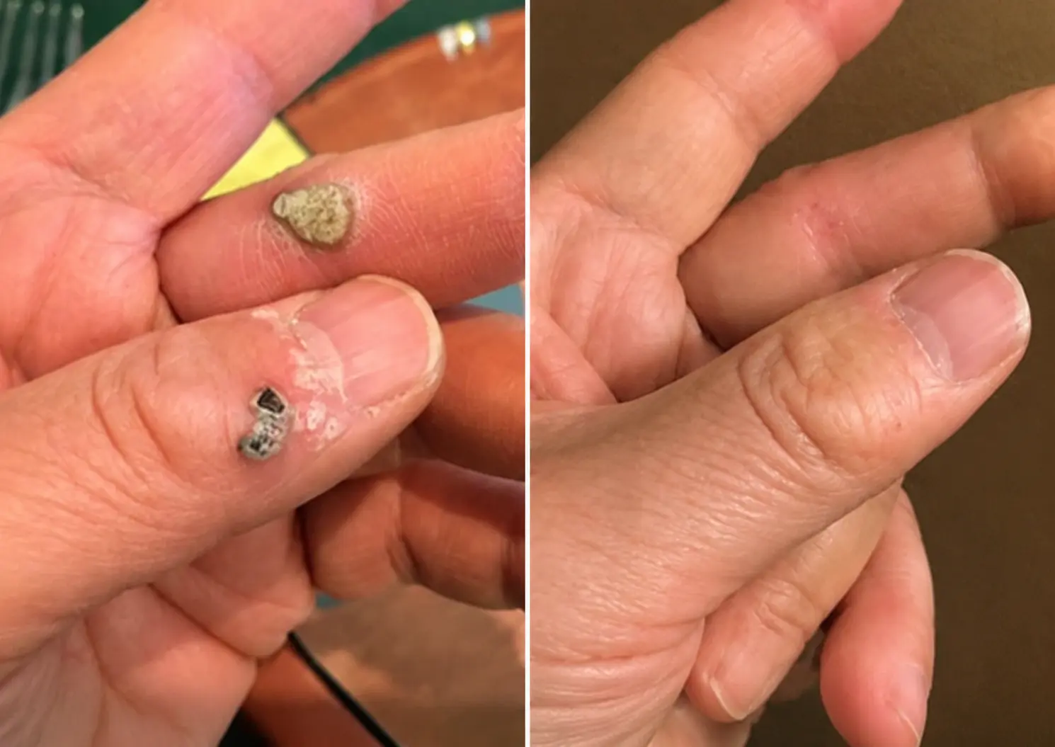 KLENIMORE™ 2-in-1 Microneedle & Hydrocolloid Patch