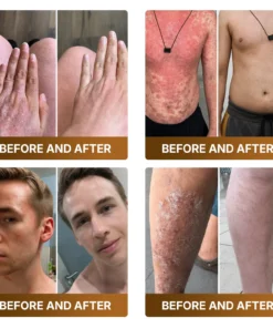 KLENIMORE™ Botox & Bee Venom Advanced Recovery Cream