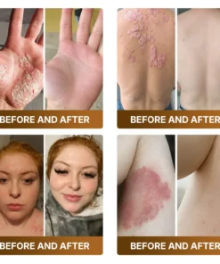KLENIMORE™ Botox & Bee Venom Advanced Recovery Cream
