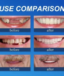 KLENIMORE™ Custom-Fit Smile Support Kit — Strong Suction Feel & Natural-Looking Fit