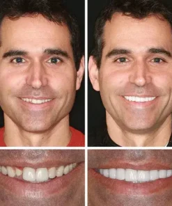 KLENIMORE™ Custom-Fit Smile Support Kit — Strong Suction Feel & Natural-Looking Fit