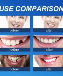 KLENIMORE™ Custom-Fit Smile Support Set