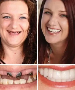 KLENIMORE™ Custom-Fit Smile Support Set