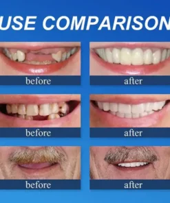 KLENIMORE™ Custom-Fit Smile Support Set