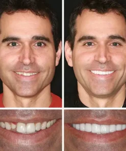 KLENIMORE™ Custom-Fit Smile Support Set