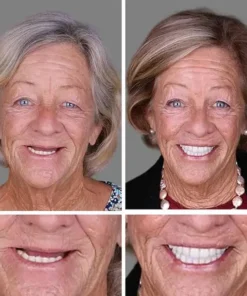 KLENIMORE™ Custom-Fit Smile Support Set