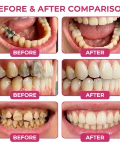 KLENIMORE DenPerm Cavity-Repair Natural Enamel Filling Gel