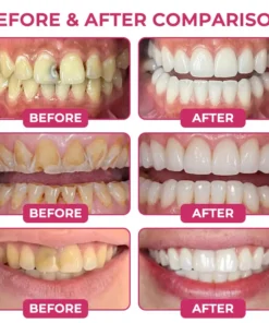 KLENIMORE DenPerm Cavity-Repair Natural Enamel Filling Gel
