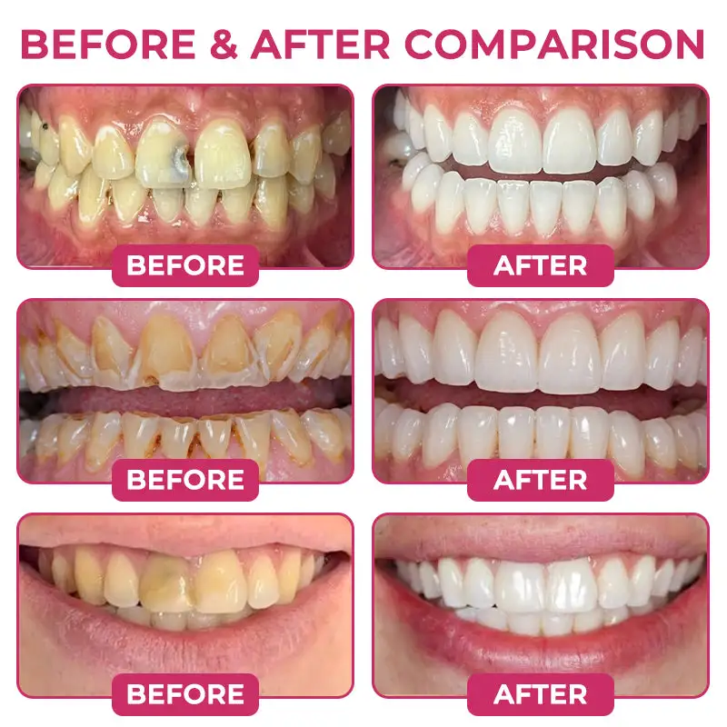 KLENIMORE DenPerm Cavity-Repair Natural Enamel Filling Gel
