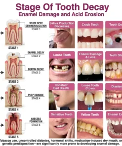KLENIMORE DenPerm Cavity-Repair Natural Enamel Filling Gel